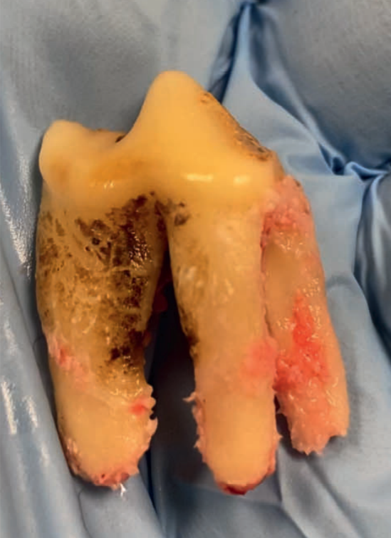 Extracted dog tooth