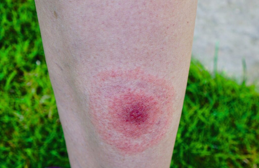 A Lyme disease vaccine is finally close: what it means for stalkers